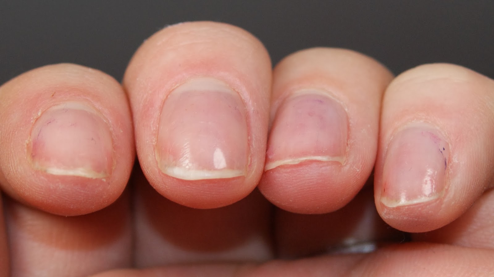 Почему ногти становятся тонкими. Ониходистрофия, лейконихия.