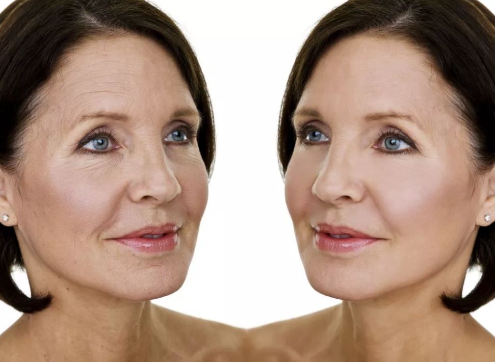эффект фотоомоложения кожи лица